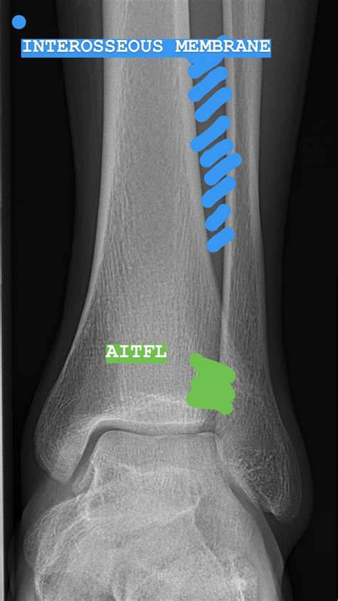 FLOW PHYSIO CO - FLOW KNOWS - Syndesmosis injury - High ankle sprains