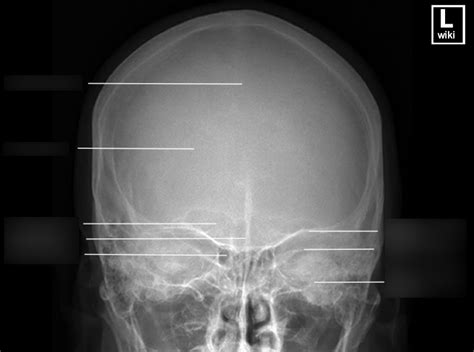 RADR 2431 PA Skull x-ray anatomy Diagram | Quizlet