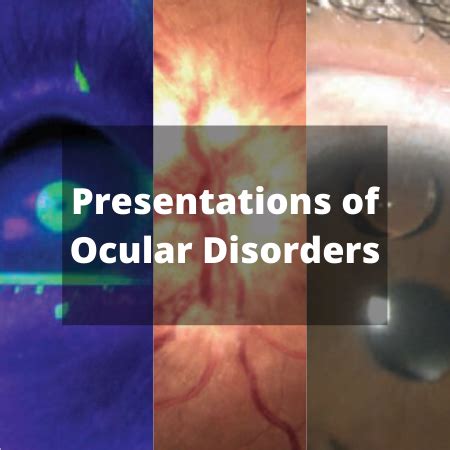 Slideshow: Presentations of Ocular Disorders