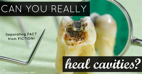 Dental Truths and Myths: Can you REALLY heal cavities? And more ...