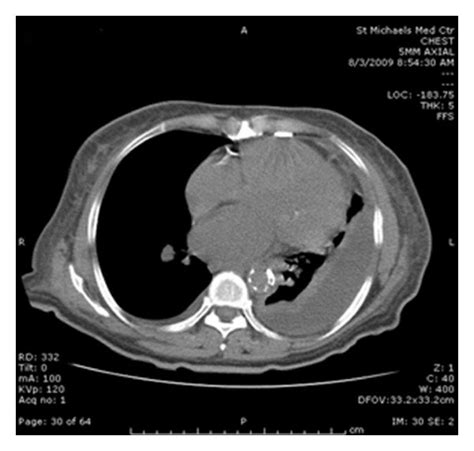 Pleural Effusion On CT Scan