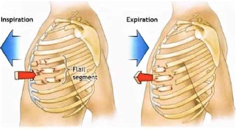 Flail chest definition, causes, symptoms, diagnosis, treatment & prognosis