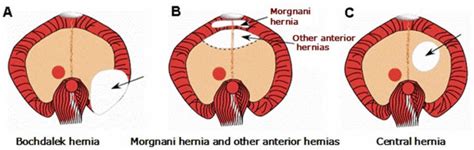 Diaphragmatic hernia causes, symptoms, diagnosis, treatment & prognosis