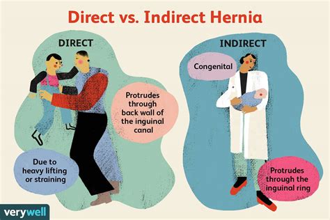 Direct Inguinal Hernia Repair