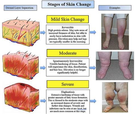 What is Lymphedema – Arkansas Lymphedema Therapy