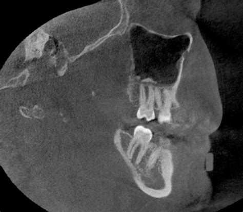 Case of the Week: Antrolith – Dr. G's Toothpix