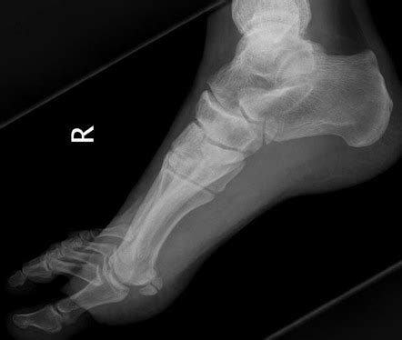 Accessory navicular | Radiology Reference Article | Radiopaedia.org