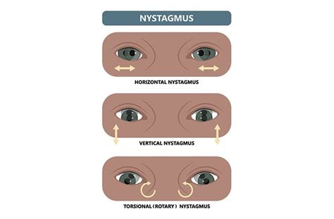 Nystagmus: Definition, Causes Treatment, 55% OFF