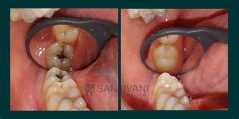 Tooth filling procedure | cost | Type of dental filling material