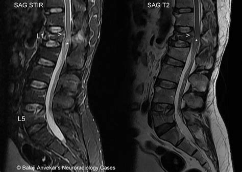 Dr Balaji Anvekar FRCR: Compression fracture with cord contusion