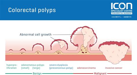 Colorectal polyps — Icon Specialist Centre