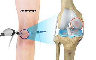 Arthroscopic Chondroplasty | Seacoast Orthopedics & Sports Medicine, Newburyport, MA