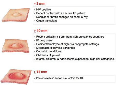 Classification of the PPD (Tuberculin Skin Test) Reaction - MEDizzy