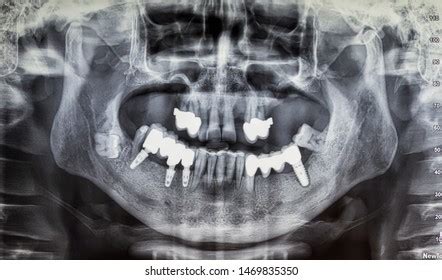 Dental Implant Xray