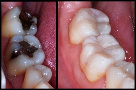 What Are Composite Fillings Used For - wehrpflicht deutschland