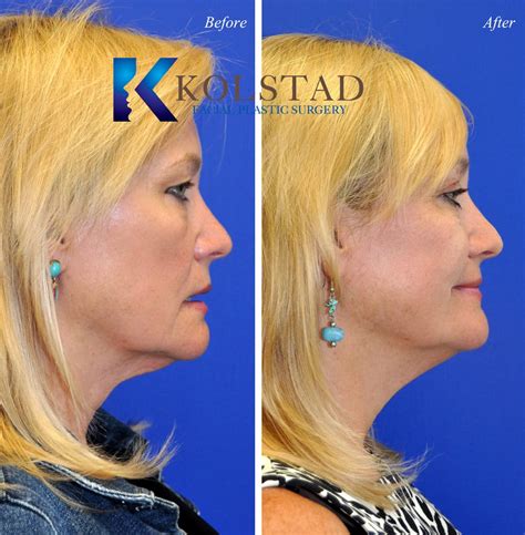 cosmetic eyelid surgery san diego 438 copy | Dr. Kolstad - San Diego ...