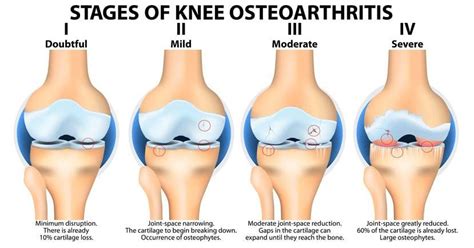 Osteoarthritis: Causes, Symptoms & Arthritis | Lucky Feet Shoes