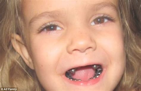 Dentist put silver crowns on every one of little girl's teeth | Daily ...