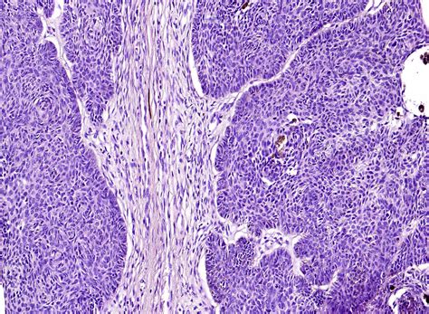 Morpheaform Basal Cell Carcinoma Histology