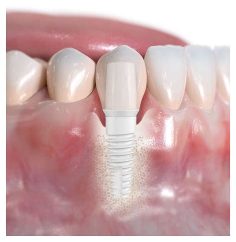 Ceramic Implants vs Titanium Implants - London Specialist Dentists