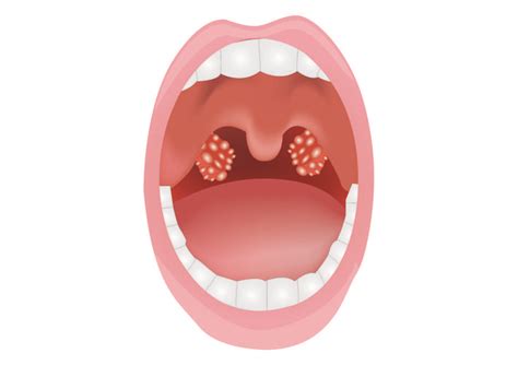 Tonsillitis in Adults: Causes, Symptoms, and Treatment