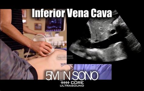 IVC (2021) – Core Ultrasound