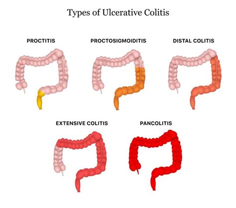 Ulcerative Colitis | Causes, Symptoms, Types & Treatments