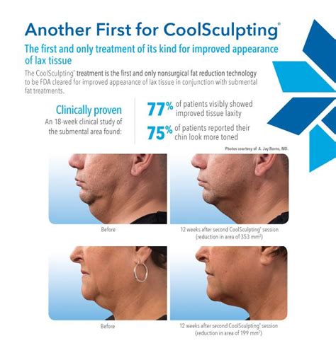 Coolsculpting for Chin - Chicago Cosmetic Surgery and Dermatology ...