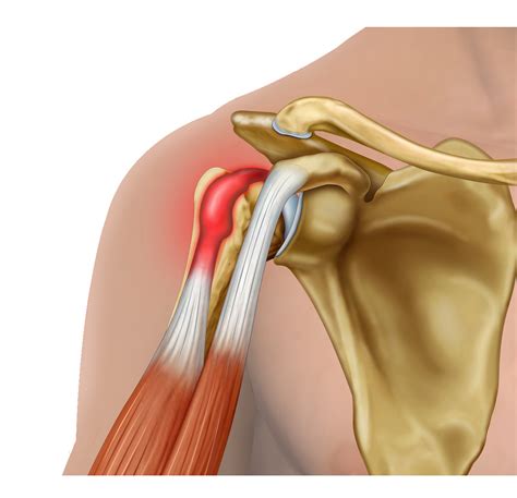 Orthopaedic & Trauma Surgeon - Shoulder - Biceps tendonitis