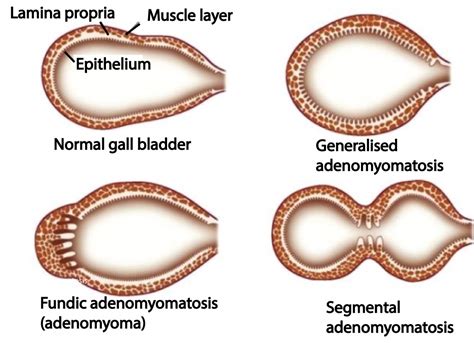 Pitfall - Stones in the gall bladder - Adenomyomatosis - Critical Care ...