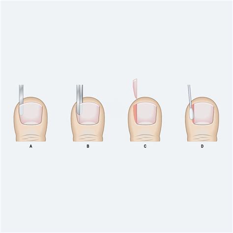 Removal of ingrown toenail surgery (Wedge Resection) - Manadr