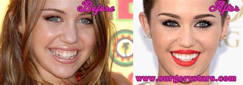 Miley Cyrus Teeth Before and After Pictures