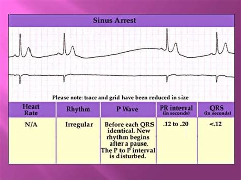 Sick sinus syndrome-dr munazza