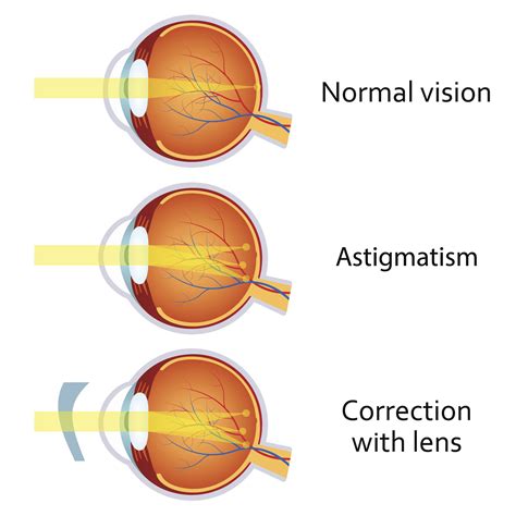 What is Astigmatism? | FramesDirect.com