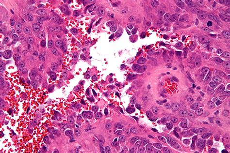 File:Epithelioid angiosarcoma - very high mag.jpg - Wikimedia Commons