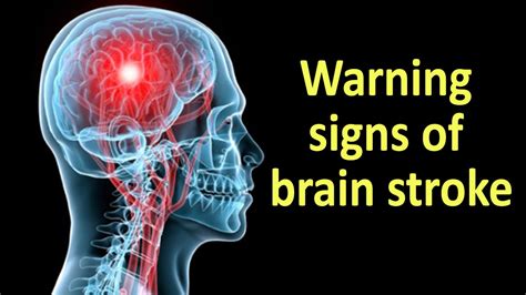 Warning Signs of Brain Stroke || Health Tips - YouTube