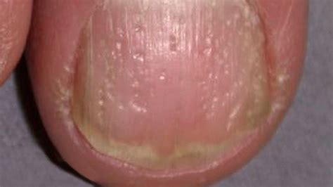 Nail Psoriasis: Pictures, Symptoms, and Treatments