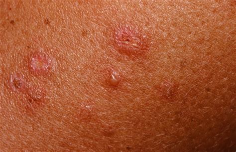 Dermatitis herpetiformis causes, symptoms, diagnosis and treatment