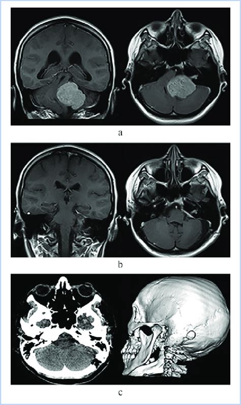 Surgical treatment of acoustic neuroma. MRI of the brain. a -a large ...