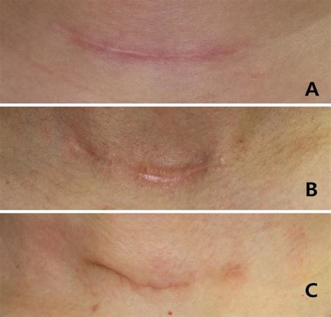 Three types of scars formed after transverse cervical incision for... | Download Scientific Diagram