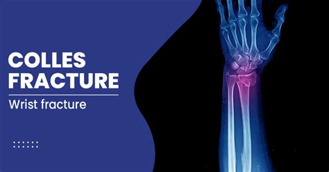 Colles Fracture - Types, Symptoms, and Treatments