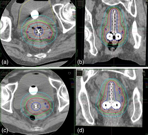 A hybrid technique of intracavitary and interstitial brachytherapy for locally advanced cervical ...