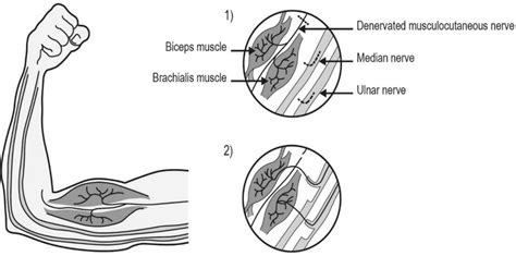 Nerve transfer to reanimate elbow flexion⁴³. Restoration of elbow ...