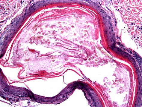 Eruptive vellus hair cyst - Dermatology Advisor