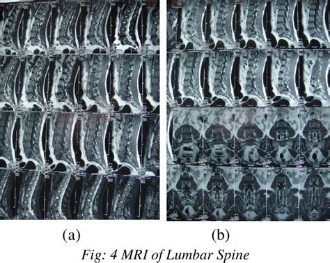 Figure 2 from Discitis after spinal anaesthesia in lower limb surgery ...