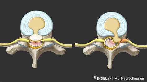 Herniated Disc Thoracic Mri