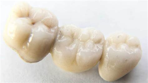 Dental Bridge: 4 Types, Benefits, Use Case and Costs