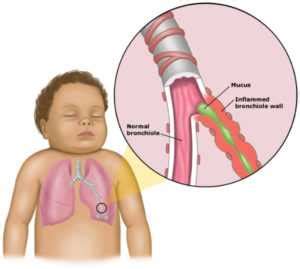 Protect your Child from Bronchitis with Homeopathy! | Dr. Thind