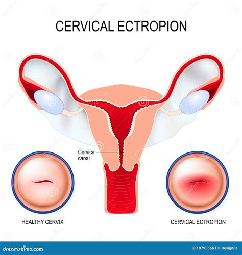 Cervical Ectropion Stock Illustrations – 5 Cervical Ectropion Stock Illustrations, Vectors ...