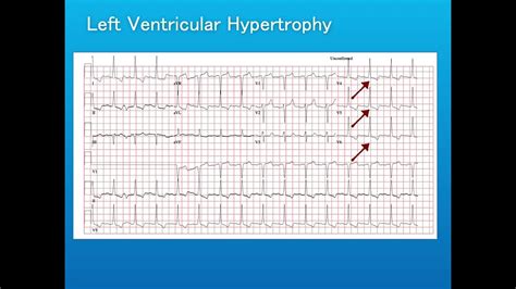 ECG interpretation T waves & abnormality - YouTube